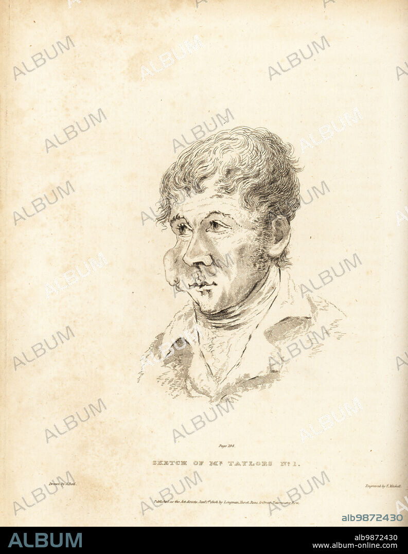 Facial tumor in the cheek of Mr Taylor, a 30-year-old Irish man from Cook Town, County Tyrone. The cancerous growth grew in the cheek and inside the mouth. Sketch of Mr. Taylors No. I. Copperplate engraving by Edward Mitchell after an illustration by John Bell from his own Principles of Surgery, as they Relate to Wounds, Ulcers and Fistulas, Longman, Hurst, Rees, Orme and Brown, London, 1815.
