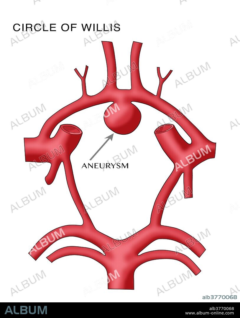 Aneurysm in the Circle of Willis. The circle of Willis (also called Willis' circle, loop of Willis, cerebral arterial circle, and Willis polygon) is a circulatory anastomosis that supplies blood to the brain and surrounding structures. It is named after Thomas Willis (1621-1675), an English physician.