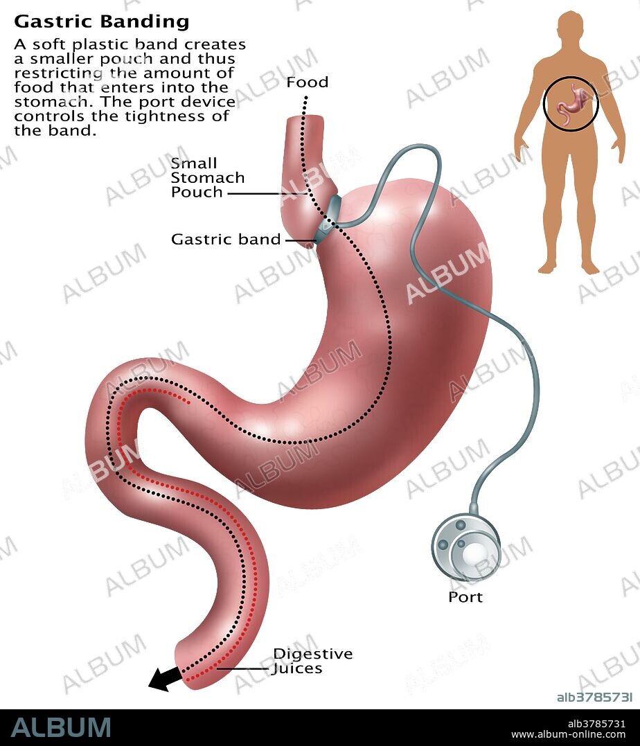 Illustration of gastric banding. A laparoscopic adjustable gastric band, commonly called a lap-band, A band, or LAGB, is an inflatable silicone device placed around the top portion of the stomach to treat obesity, intended to slow consumption of food and thus reduce the amount of food consumed. A soft plastic band creates a smaller pouch, thus restricting the amount of food that enters into the stomach. The port device controls the tightness of the band.