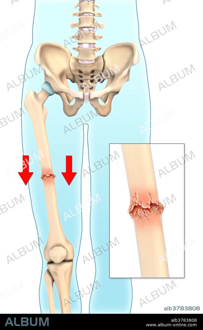 An illustration of an impacted fracture in which bone fragments are driven into each other.