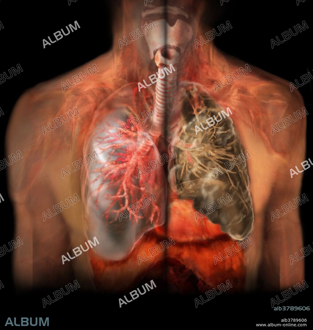 3-D visualization using scanned human data of a healthy lung compared with a smoker's lung. Smoking damages the lungs in several ways. Constant irritation by tar in smoke causes chronic bronchitis, where the lung's airways are repeatedly inflamed. This thickens their walls and leads to a build up of fibrous scar tissue, reducing the lung's elasticity. Smoke also triggers the release of substances that make the lung's air sacs (alveoli) lose their walls and coalesce (emphysema). Lung cancer, which is caused by both nicotine and tar, leads to uncontrollable tumors that destroy lung tissue.