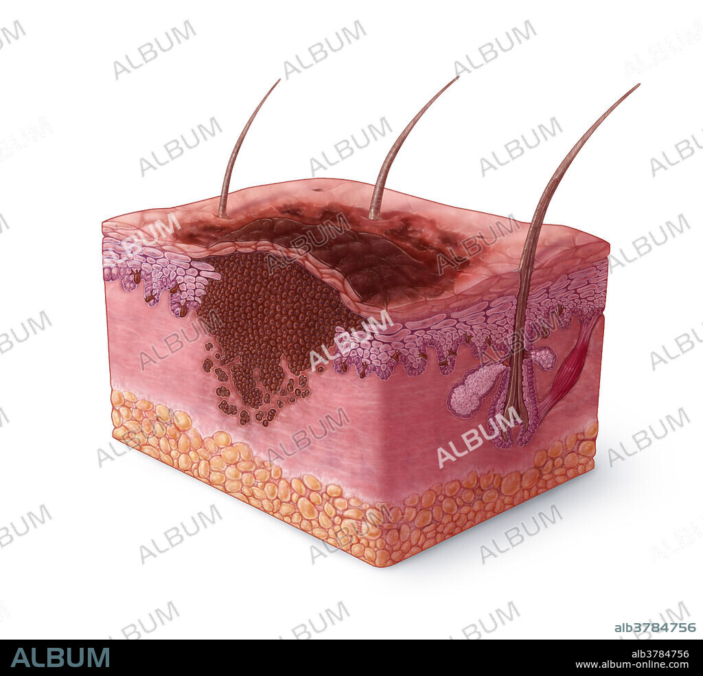 An illustration of melanoma, a type of skin cancer that develops in melanocytes, creating asymmetrical moles with irregular borders and discoloration. Melanocytes produce melanin, the pigment which gives colour to the skin. Prolonged exposure to ultraviolet (UV) light can damage melanocyte DNA, causing cells to replicate out of control and even spread to other parts of the body.