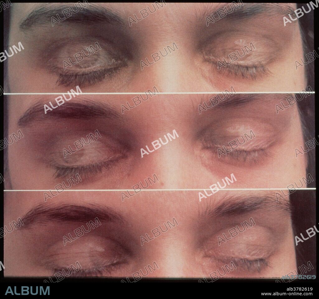 Eye movement during REM sleep. Photograph illustrating REM (Rapid Eye Movement), the deepest of five stages of sleep. During this stage, the muscles of the eyes are in constant motion behind the closed eyelids. People woken abruptly during REM sleep often report that they were dreaming at the time. Photographed using double-exposure techniques.