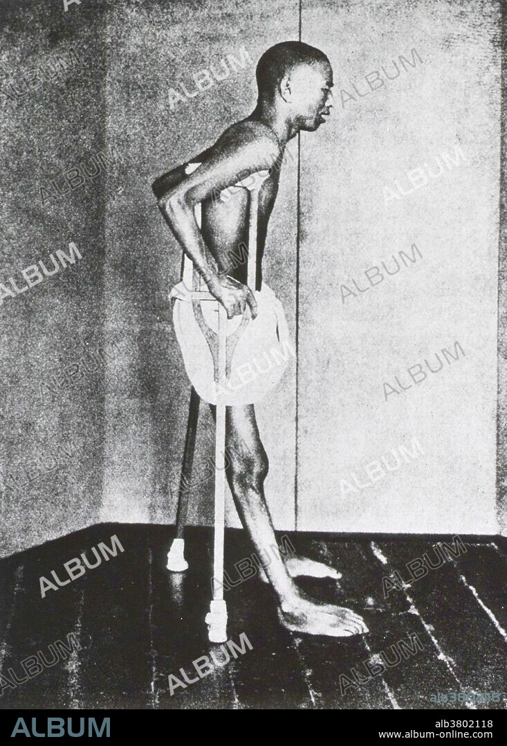 Beriberi Patient, 1914