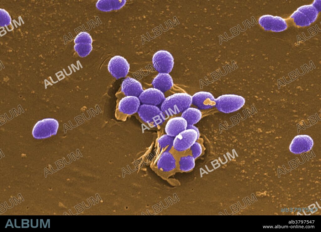 Color-enhanced Scanning Electron Micrograph (SEM) showing large numbers of Gram-positive Enterococcus faecalis bacteria. Enterococci, leading causes of nosocomial bacteremia, surgical wound infection, and urinary tract infection, are becoming resistant to many and sometimes all standard therapies. New rapid surveillance methods are highlighting the importance of examining enterococcal isolates at the species level.