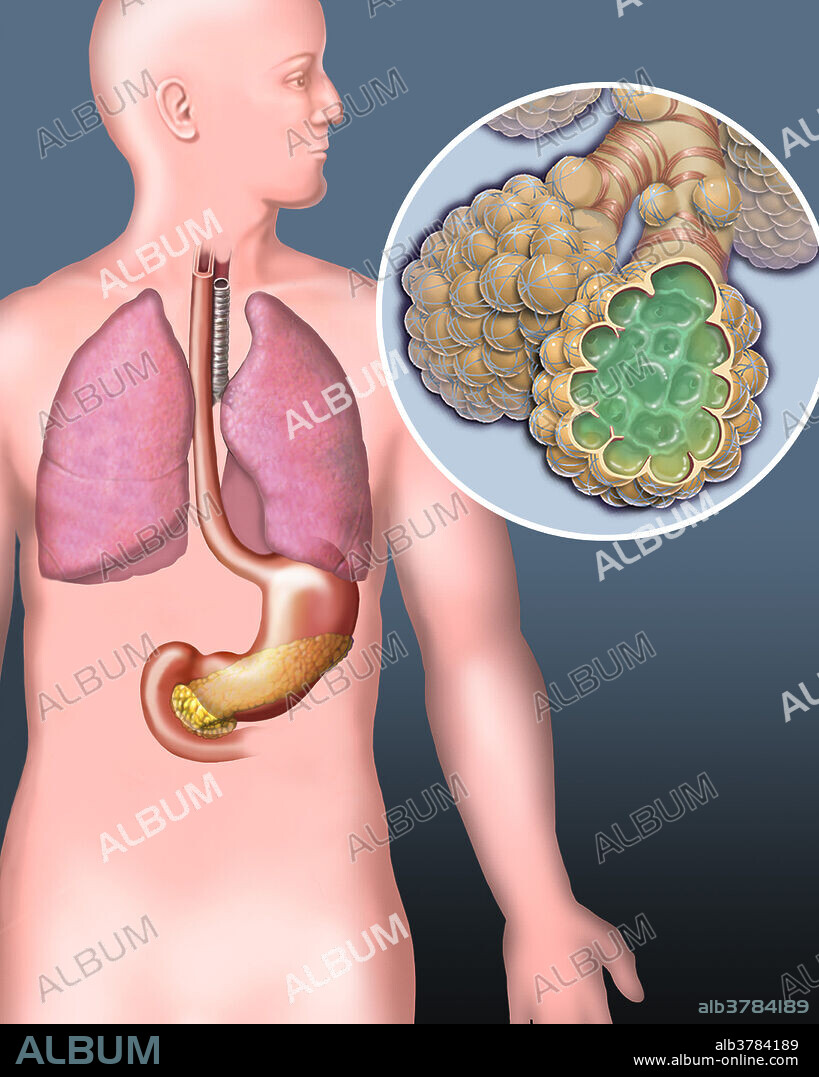 Medical illustration of a human showing the lungs, esophagus, trachea, stomach, pancreas and duodenum. An enlargement of the lung's alveoli illustrates mucus that damages the respiratory system.
