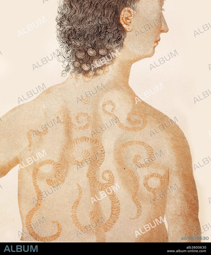 Color plate showing psoriasis gyrata on the back, 1808. Psoriasis gyrata is a rare form of psoriasis in which curved linear patterns predominate.