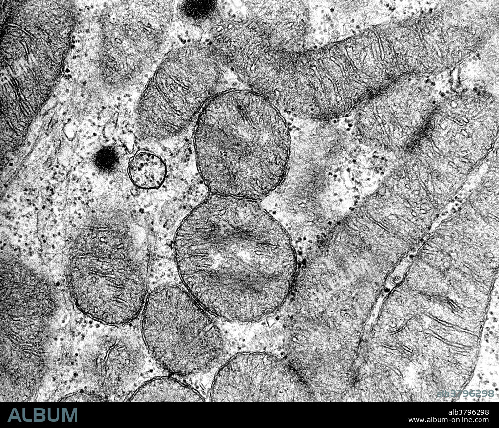 TEM of a dividing mitochondrion in a cell of a human oncocytoma, a rare benign tumor of the human parotid salivary gland. The mitochondrion is divided into two by a membranous partition, and shows constriction at the level of partition. Continued ingrowth of the outer mitochondrial membrane into the partition will eventually result in the formation of two daughter mitochondria. Magnification @ 75,000x.
