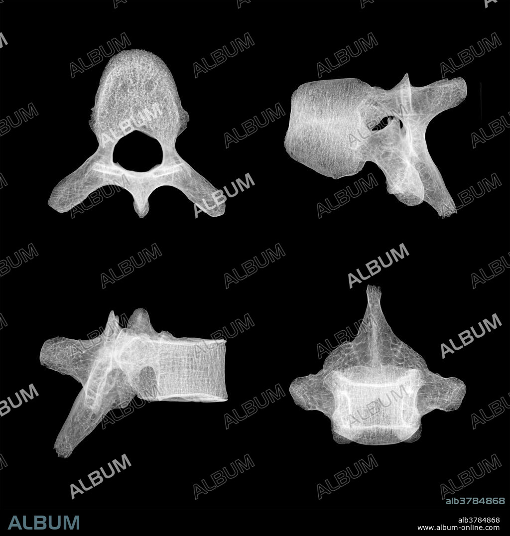X-ray showing four different views of human lumbar vertebra T5.