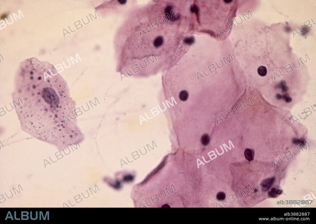 A cytologic smear of vagina with intermediate squamous cells, one of which contains numerous keratohyalin granules (Papanicolaou stain, x 1000).