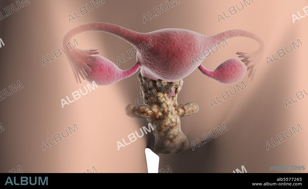 Medical illustration of cervical cancer.