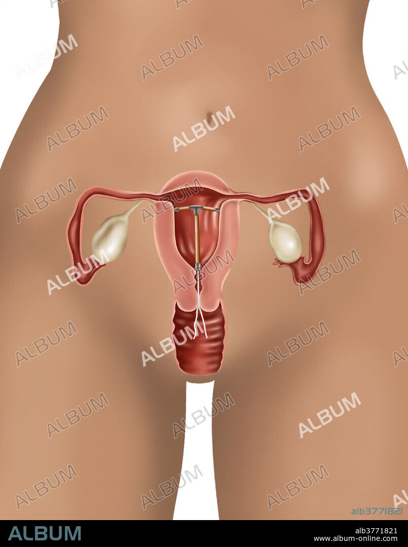 Illustration of an IUD contraceptive device inserted through the cervix and into the uterus.