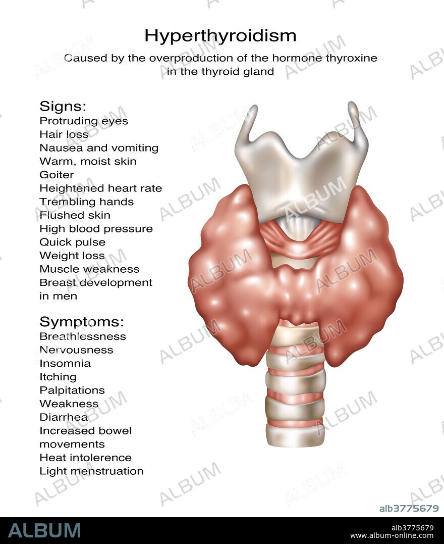 Hyperthyroidism, Illustration