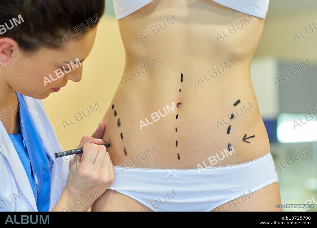 Abdomen. Tummy tuck. It is retensioning skin and abdominal muscles, by removing redundant skin and musculature plication. Before surgery should be taken anatomical references, such as the midline of the abdomen and the height of the anterior superior iliac spine. Plastic surgery. Doctor attending to patient medical consultation.