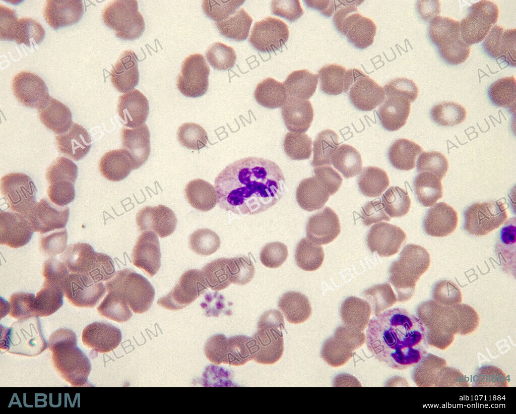 Rouleaux (singular is rouleau) are stacks or aggregations of erythrocytes. Conditions which cause rouleaux formation include infections, myeloma, inflammatory and connective tissue disorders, and cancers. It also occurs in diabetes mellitus. Light micrograph, Wright-Giemsa stain. Magnification: 100x.