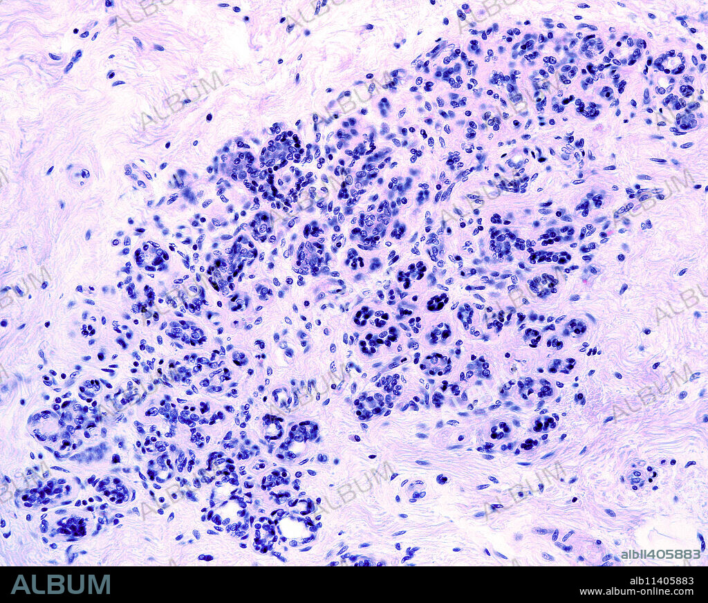 Breast adenosis (sclerosing adenosis) is a frequent non-cancerous change consisting in an increase in glandular elements plus stromal proliferation that distorts and compresses glands. Light micrograph.