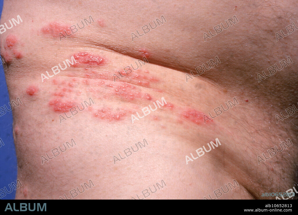 Shingles, (Herpes zoster), lesions showing distribution along one side of the belt line.