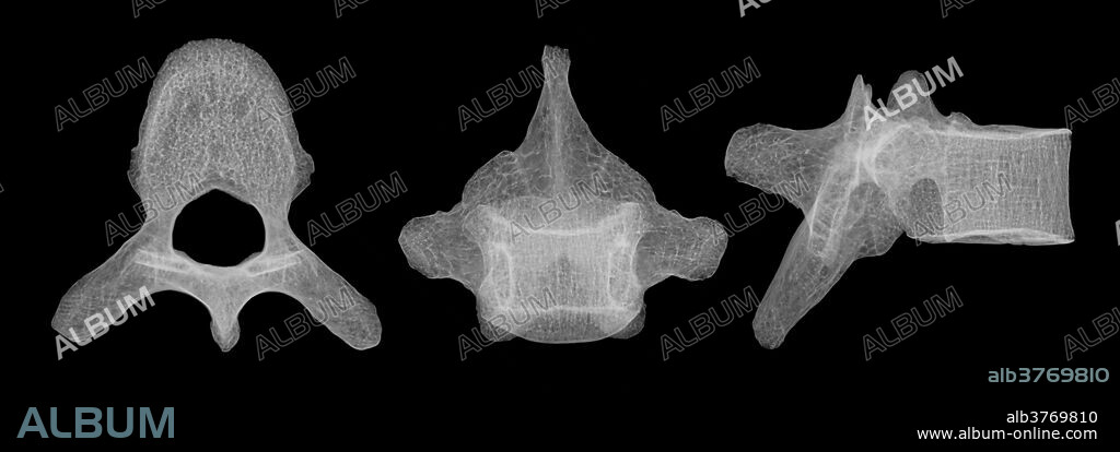 X-ray showing three different views of human lumbar vertebra T5.