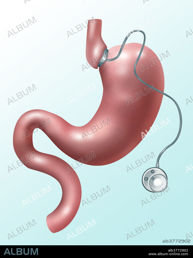 Illustration of gastric banding. A laparoscopic adjustable gastric band, commonly called a lap-band, A band, or LAGB, is an inflatable silicone device placed around the top portion of the stomach to treat obesity, intended to slow consumption of food and thus reduce the amount of food consumed. A soft plastic band creates a smaller pouch, thus restricting the amount of food that enters into the stomach. The port device controls the tightness of the band.