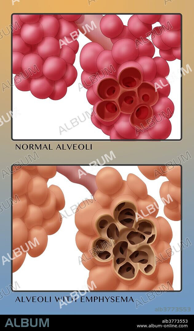 Illustration comparing the appearance of healthy alveoli (top) and alveoli with emphysema (bottom). Alveoli are located in the lungs. They are small air sacs at the end of the respiratory tree. Emphysema, a disease in which the alveoli become damaged, is commonly caused by smoking tobacco.