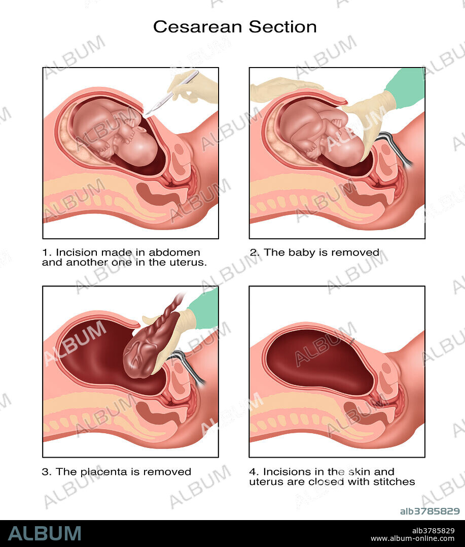 Illustration diagramming a caesarean section. 1. An incision is made in the abdomen and another one in the uterus. 2. The baby is removed. 3. The placenta is removed, 4. Incisions in the skin and uterus are closed with stitches.