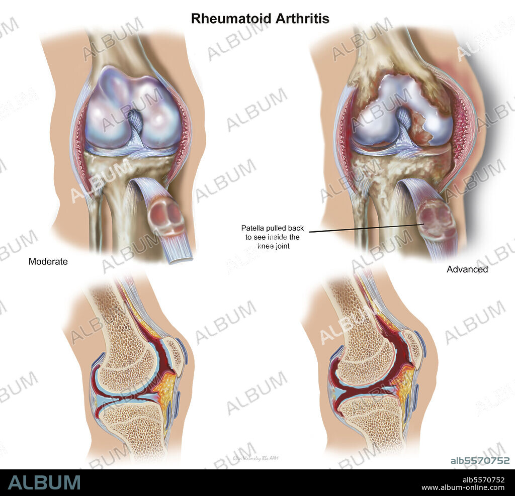 Front view and cross section of knee showing moderate and advancd rheumatoid arthritis.