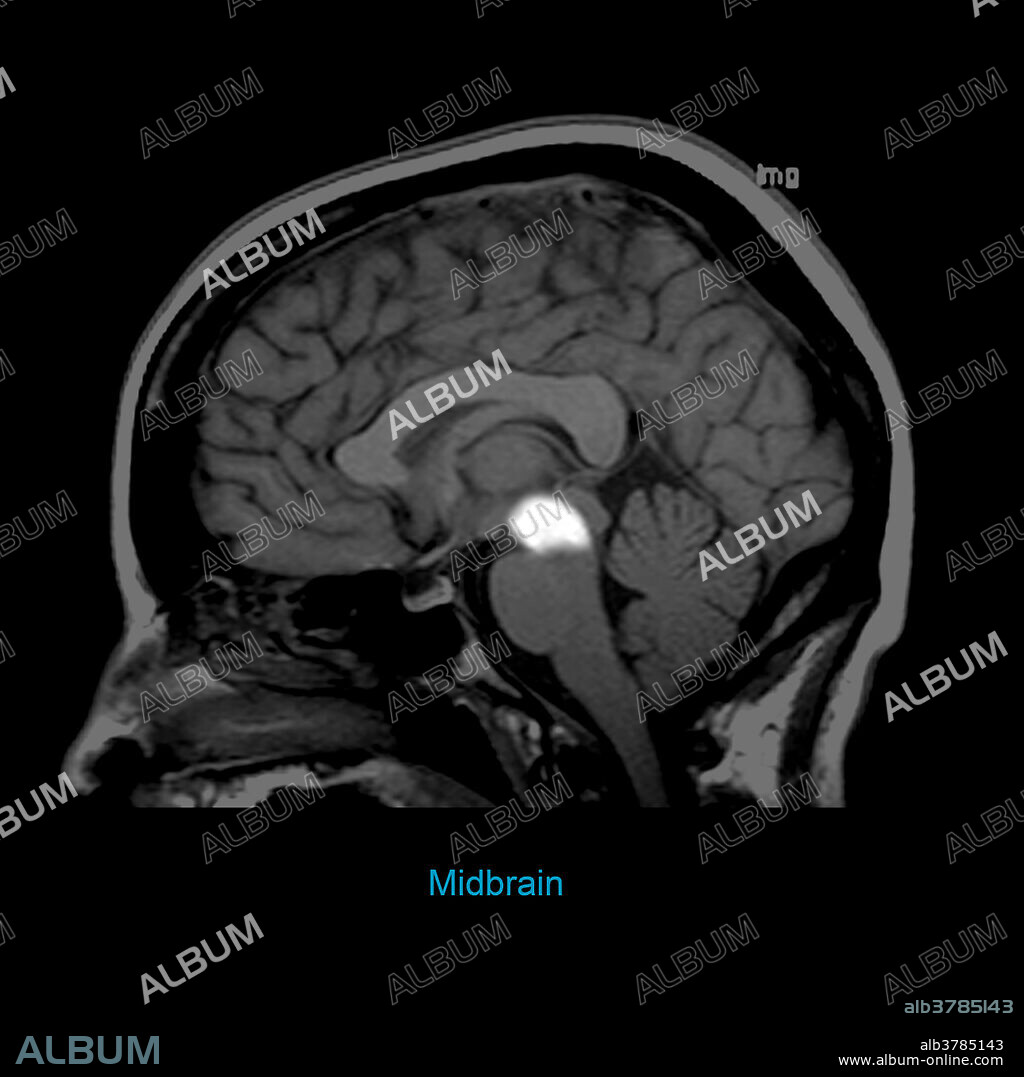 This T1 weighted sagittal (from the side) MRI image of the brain highlights the midbrain (mesencephalon).