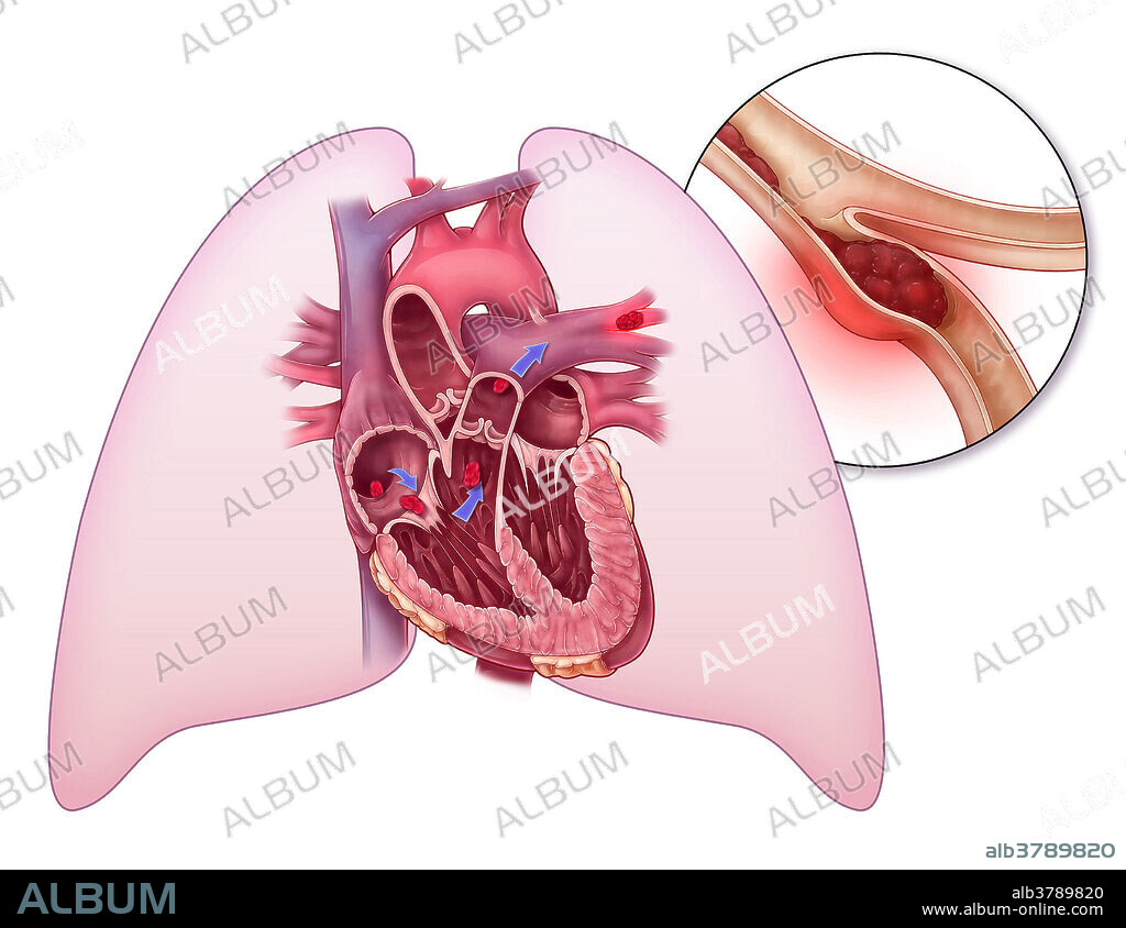Pulmonary Embolism, Illustration