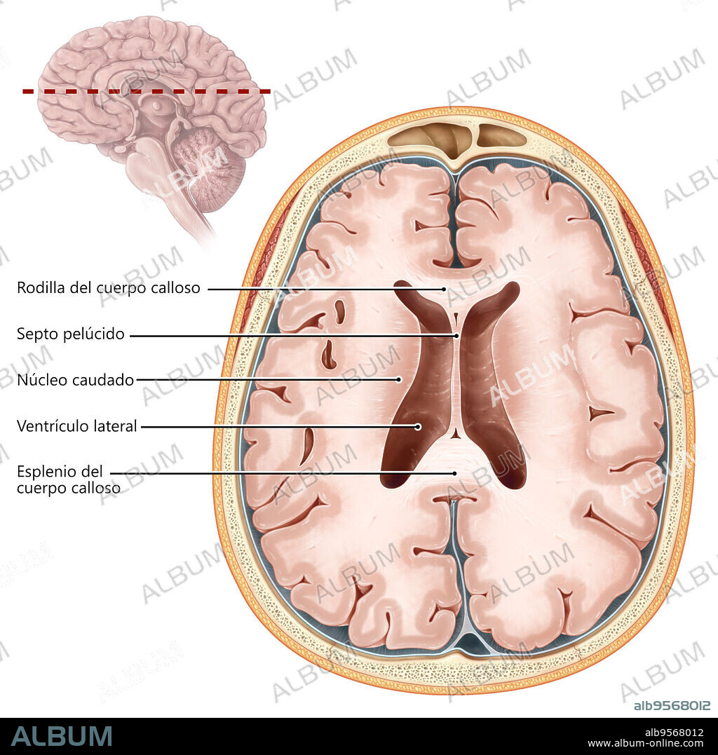 An illustrated transverse section of the brain depicting the body of the lateral ventricle, the genu and splenium of the corpus callosum, and the caudate nucleus. (The brain's the white matter is colored light beige and the grey matter of the cerebral cortex is dark beige).