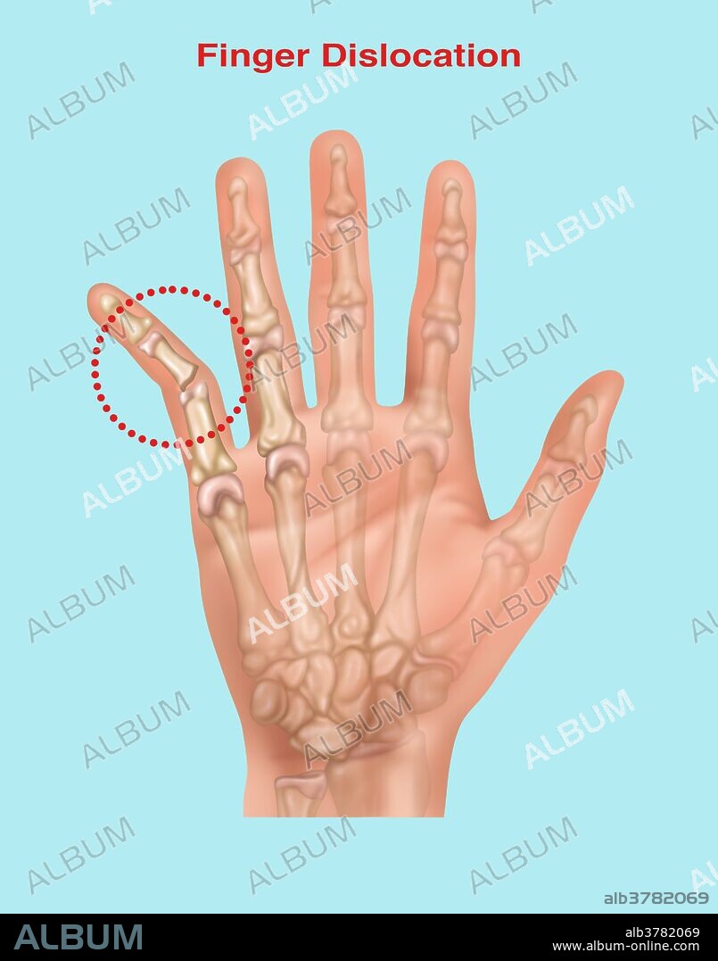 Illustration showing a dislocated little (or 5th) finger.