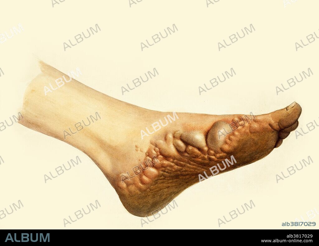 A foot with disease designated as pompholyx. Watercolor by Mabel Green, 1906. Pompholyx is a form of hand/foot eczema characterized by vesicles or bullae (blisters). It is a form of vesicular dermatitis of hands and feet, also called vesicular endogenous eczema, and may be the same condition as dyshidrotic eczema.
