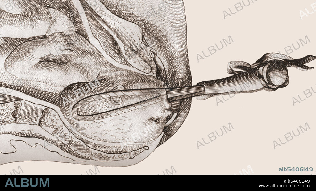 Smellie forceps. William Smellie (1697-1763) was a Scottish obstetrician and medical instructor who practiced and taught primarily in London. One of the first prominent male midwives in Britain, he designed an improved version of the obstetrical forceps, established safer delivery practices, and through his teaching and writing helped make obstetrics more scientifically based.
