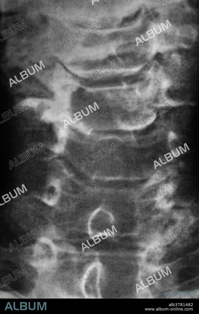 X-ray of the spine showing cervical spondylosis.