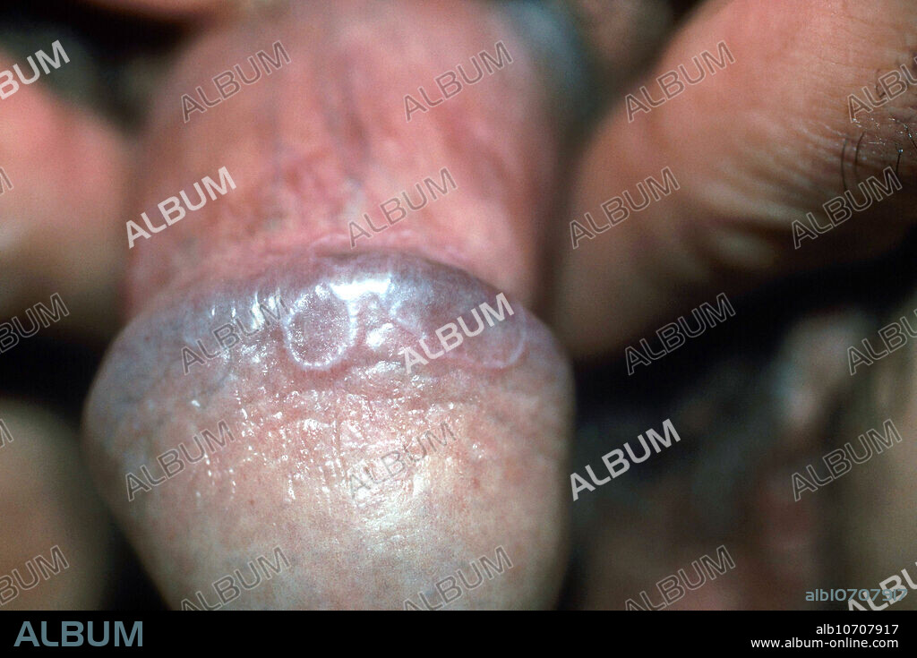 Lichen planus on the penis of a patient. Lichen planus is a common inflammatory disorder of the skin and mucous membranes characterized by purplish, itchy, flat-topped bumps. The cause is unknown.