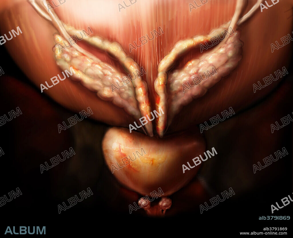 Posterior view of the prostate gland, seminal vesicles, ductus deferens and Cowpers glands (also known as the bulbourethral glands). The ductus deferens joins with the seminal vesicles to form the ejaculatory duct. The seminal vesicles act to secrete a thick alkaline fluid that mixes with the sperm as it passes into the ejaculatory ducts and the urethra. The prostate gland secretes a lubricant that helps to prevent infection in the urethra and protects and energizes sperm. The Cowpers gland produces a thick, clear mucus that is released prior to ejaculation to neutralize traces of acidic urine within the urethra.