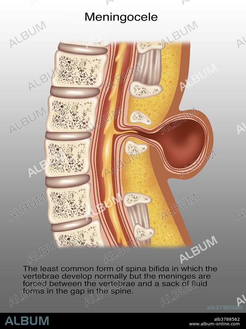 Illustration of spina meningocele. Spina meningocele is the least common form of spina bifida in which the vertebrae develop normally but the meninges are forced between the verebrae and a sack of fluid forms in the gap in the spine.