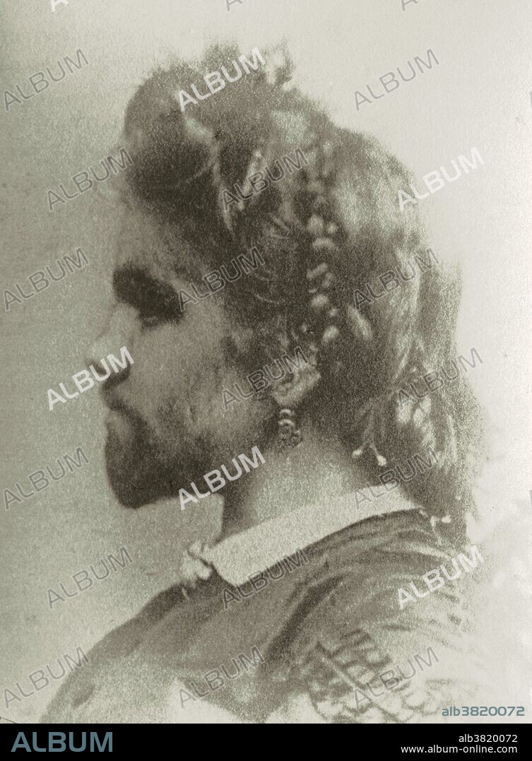 Photograph of "the Bearded Lady" Julia Pastrana, who toured Europe and North America in the 1850s. Appeared in Nikolai Nikolai Mansurov's Klinicheskii sbornik po dermatologii. Julia Pastrana (1834 - March 25, 1860) was a woman born with hypertrichosis, who took part in 19th century exhibition tours in North America and Europe. She was born with a genetic condition, hypertrichosis terminalis, her face and body were covered with straight black hair. Her ears and nose were unusually large, and her teeth were irregular. The latter condition was caused by a rare disease, undiagnosed in her lifetime, Gingival hyperplasia, which thickened her lips and gums. She was advertised as a hybrid between an ape and a human, and as a "Bear Woman". During a tour in Moscow, Pastrana gave birth to a baby with features similar to her own. The child survived only three days, and Pastrana died of postpartum complications five days later. Hypertrichosis (also called Ambras syndrome) is an abnormal amount of hair growth over the body. Extensive cases of hypertrichosis have informally been called werewolf syndrome, because the appearance is similar to the werewolf.
