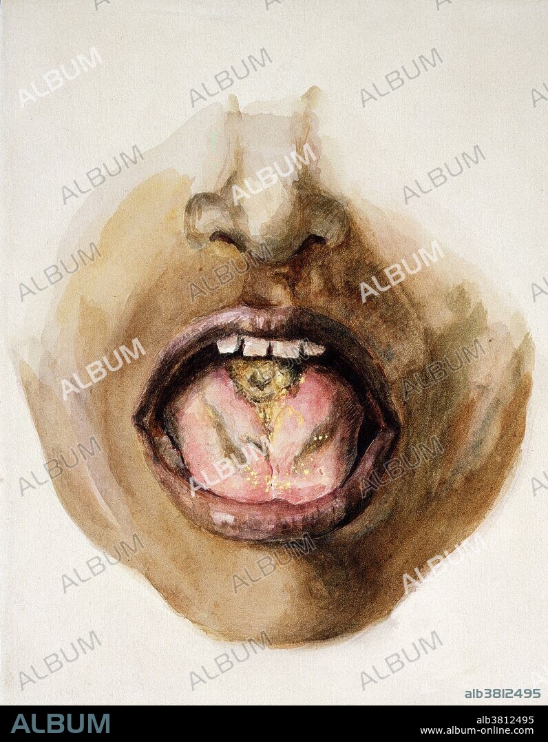 Noma in Leishmaniasis, Illustration, 1907