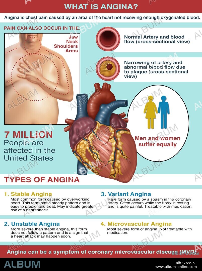 Angina is chest pain caused by an area of the heart not receiving enough oxygenated blood. It can also be a symptom of coronary microvascular disease. 7 million people are affected in the United States and men and women suffer equally. There are 4 types of angina. Stable angina, unstable angina, variant angina and microvascular angina.