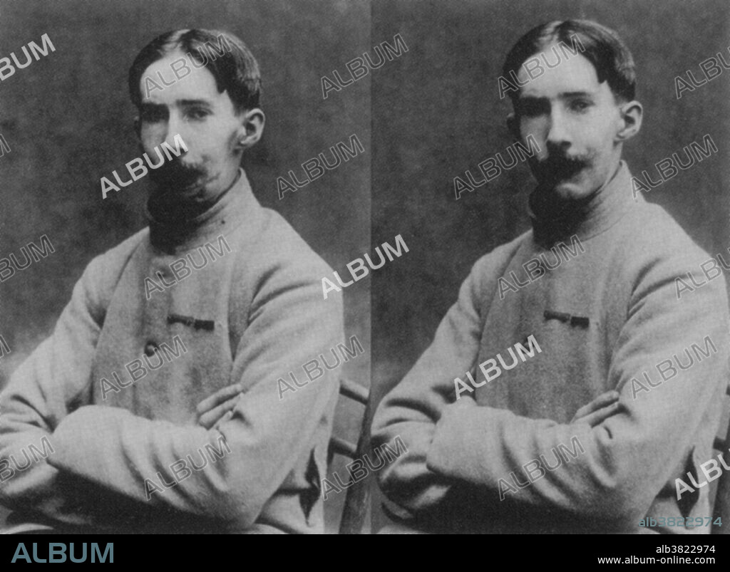 After the First World War, American sculptor Anna Coleman Ladd (1878-1939) ran the Studio for Portrait Masks in Paris, administered by the American Red Cross.  With her four assistants, she made lifelike masks for disfigured French soldiers.  Her workroom photographs document the "before and after" faces of each disfigured (left) and masked (right) soldier.  After the patient's injury and/or restorative surgeries had healed, Ladd would take a plaster cast of his face.  A mask was then crafted out of paper-thin galvanized copper and carefully painted to match skin color. Some even had real-hair mustaches. Every mask took at least month to make.  Neither function nor mobile expression could be restored, of course, but after their "plastic surgery," the grateful soldiers were able to return to their families and rejoin society without being shunned.  In 1932, Ladd was made a Chevalier of the French Legion of Honor.
