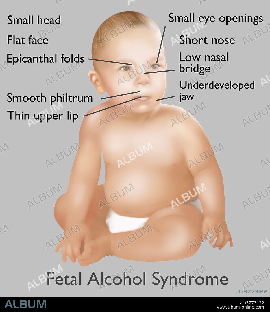 Illustration of baby with Fetal Alcohol Syndrome. Fetal Alcohol Syndrome or (FAS) is a condition in infants that is caused by alcohol consumption by the mother during time of pregnancy. Mental and physical defects such as a small head, flat face, epicanthal folds, smooth philtrum, thin upper lip, small eye openings, short nose, low nasal bridge, and underdeveloped jaw, are common symptoms of fetal exposure to alcohol.