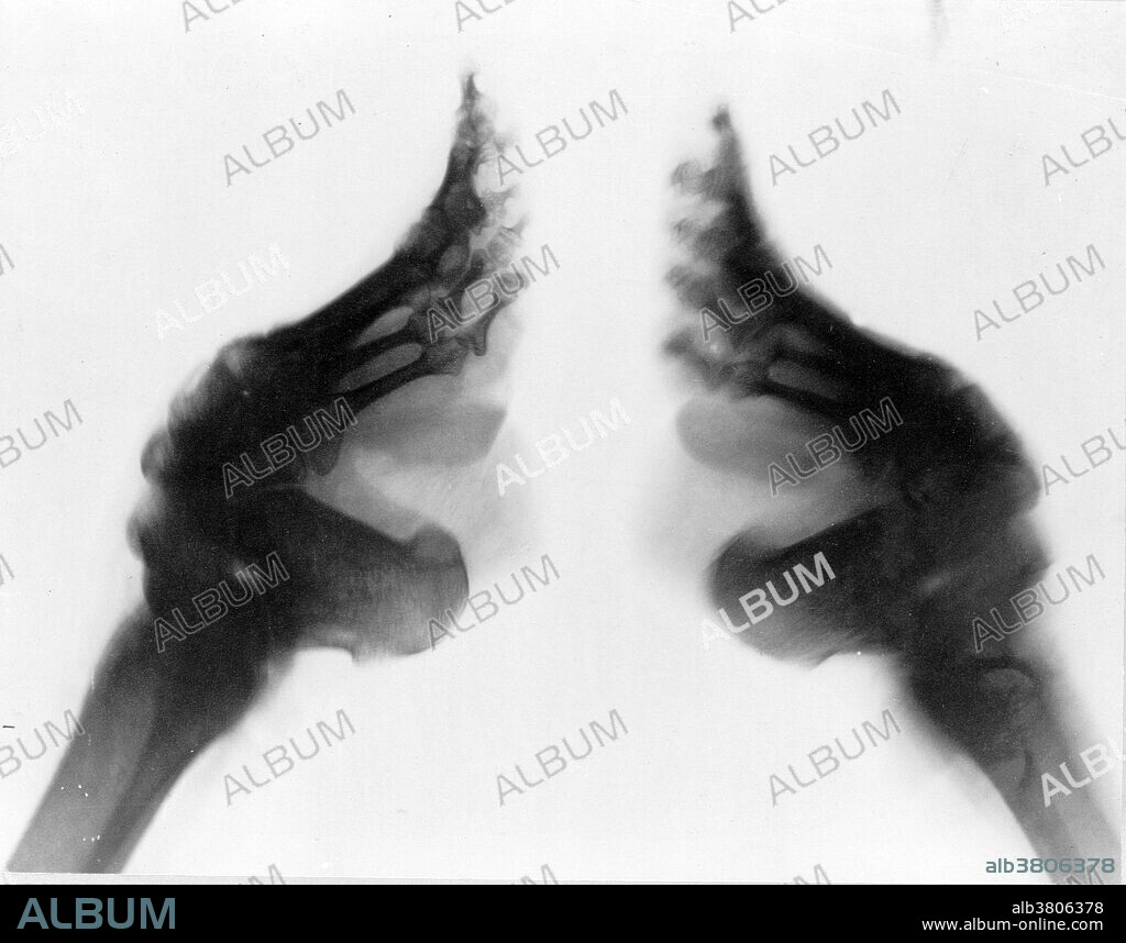 X-ray of bound feet, China, between 1890 and 1923. Foot binding was the custom of binding the feet of young girls painfully tight to prevent further growth. The tiny narrow feet were considered beautiful and to make a woman's movements more feminine and dainty. Although reformers challenged the practice, it was not until the early 20th century that foot binding began dying out. Foot-binding resulted in lifelong disabilities for most of its subjects, and some elderly Chinese women still survive today with disabilities related to their bound feet.