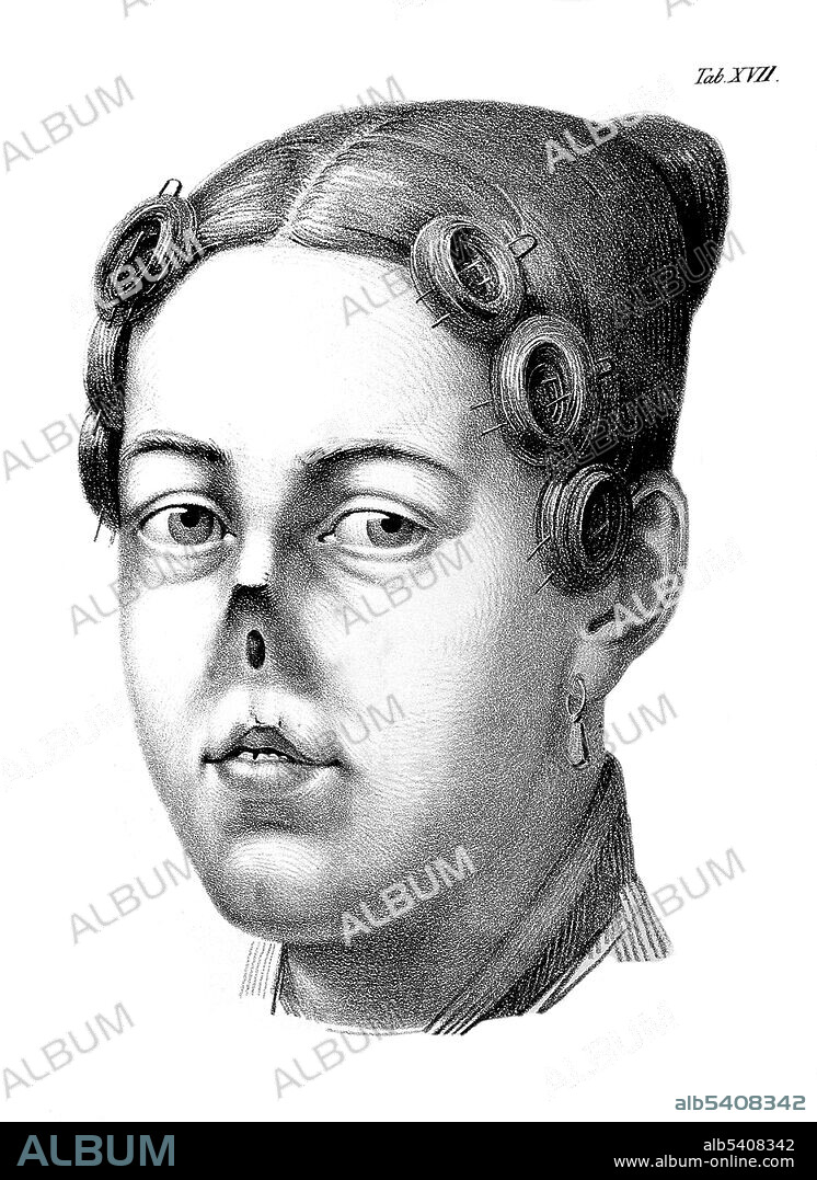Chirurgische Erfahrungen. Woman with no nose. Johann Friedrich Dieffenbach (February  1, 1792 -  November 11, 1847) was a German surgeon who specialized in skin transplantation and plastic surgery. His work in rhinoplastic and maxillofacial surgery established many modern techniques of reconstructive surgery. Before the discovery of blood typing and blood matching, Dieffenbach researched blood transfusion. In 1839, Dieffenbach performed the first successful myotomy (surgical procedure in which muscle is cut out) for the treatment of strabismus on a seven-year old boy with esotropia. He died in 1847 at the age of 55. Images appeared in Surgical experiences, especially on the restoration of damaged parts of the human body according to new methods by Johann Friedrich Dieffenbach, 1829.