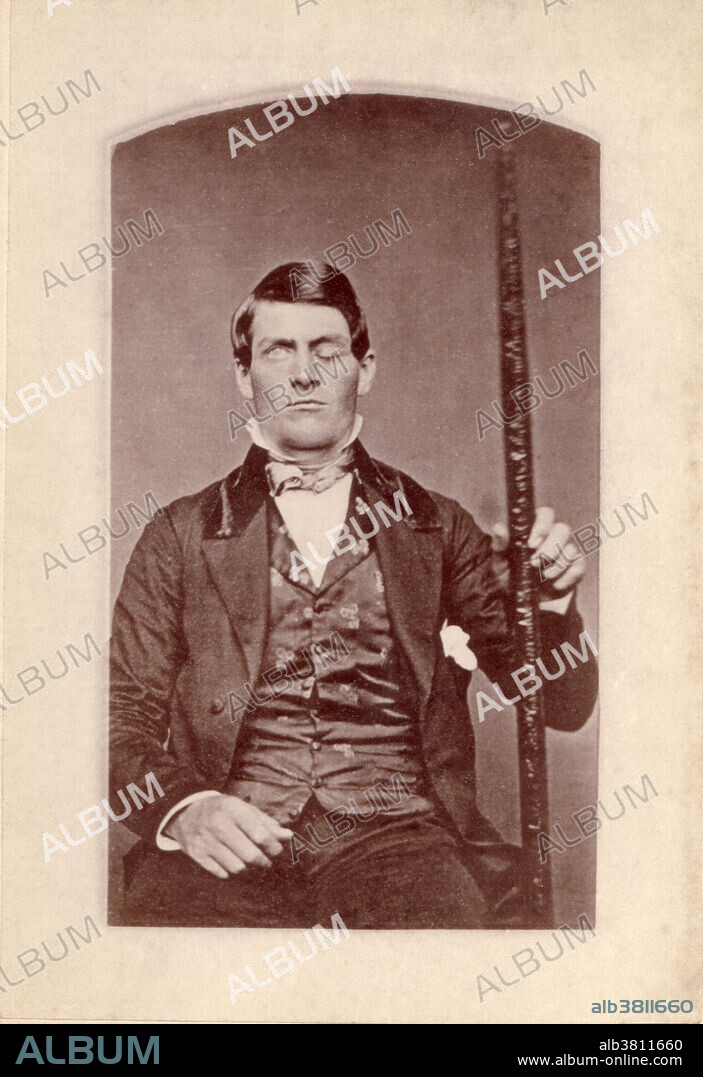 Editorial use only . Phineas P. Gage, 1823-1860, was an American railroad worker that survived an accident in which a large iron rod was driven through his head. The iron rod destroyed most of his left frontal lobe. The effects of the injury on his personality has been much debated as there is scant written evidence of what his behaviour actually was for the twelve remaining years of his life. The accident occurred on September 13, 1848.