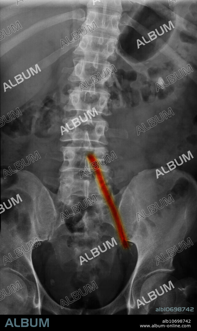 Color-enhanced X-ray of a 51-year-old man who had an aorto-iliac wire-mesh bypass graft for atherosclerotic artery disease.