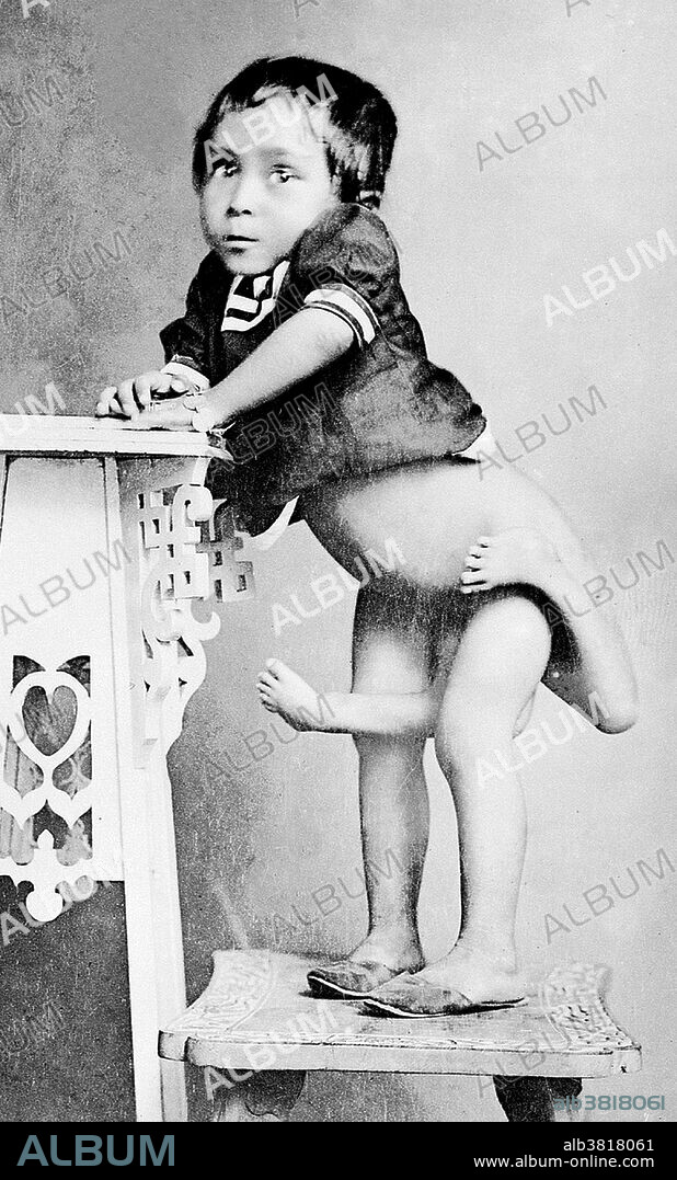Filipino child with an additional set of legs. Polymelia is a birth defect involving limbs (a type of dysmelia), in which the affected individual has more than the usual number of limbs. In humans and most land-dwelling animals, this means having five or more limbs. The extra limb is most commonly shrunken and/or deformed. Sometimes an embryo started as conjoined twins, but one twin degenerated completely except for one or more limbs, which end up attached to the other twin. No photographer credited, undated.