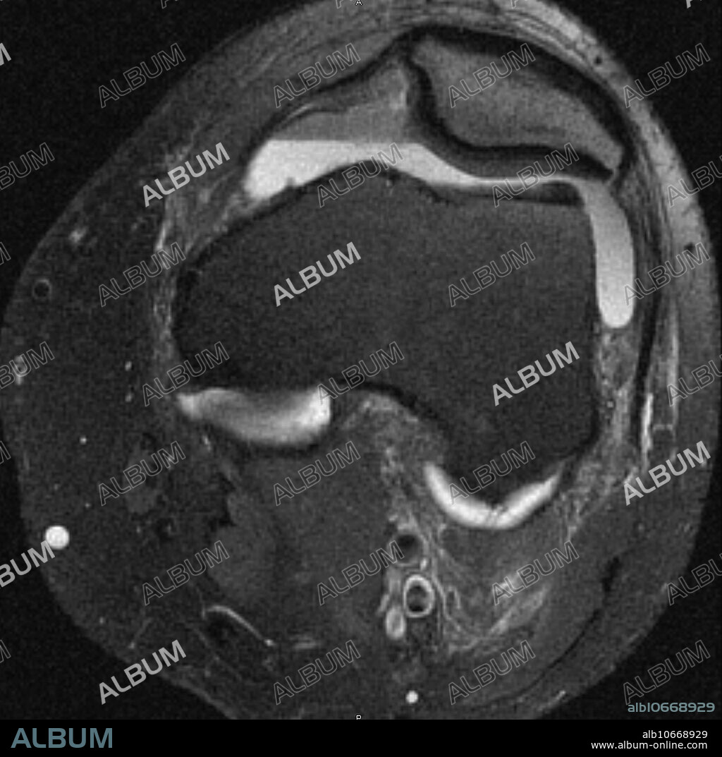 MRI of knee in 32 year old male with large complicated joint effusion which contains haematocrit fluid blood levels characteristic of hemarthrosis. Complete anterior cruciate ligament tear grade 3 sprain with associated transchondral fractures. Axial fat suppressed T2 weighted image performed on 1.5T high field MRI.