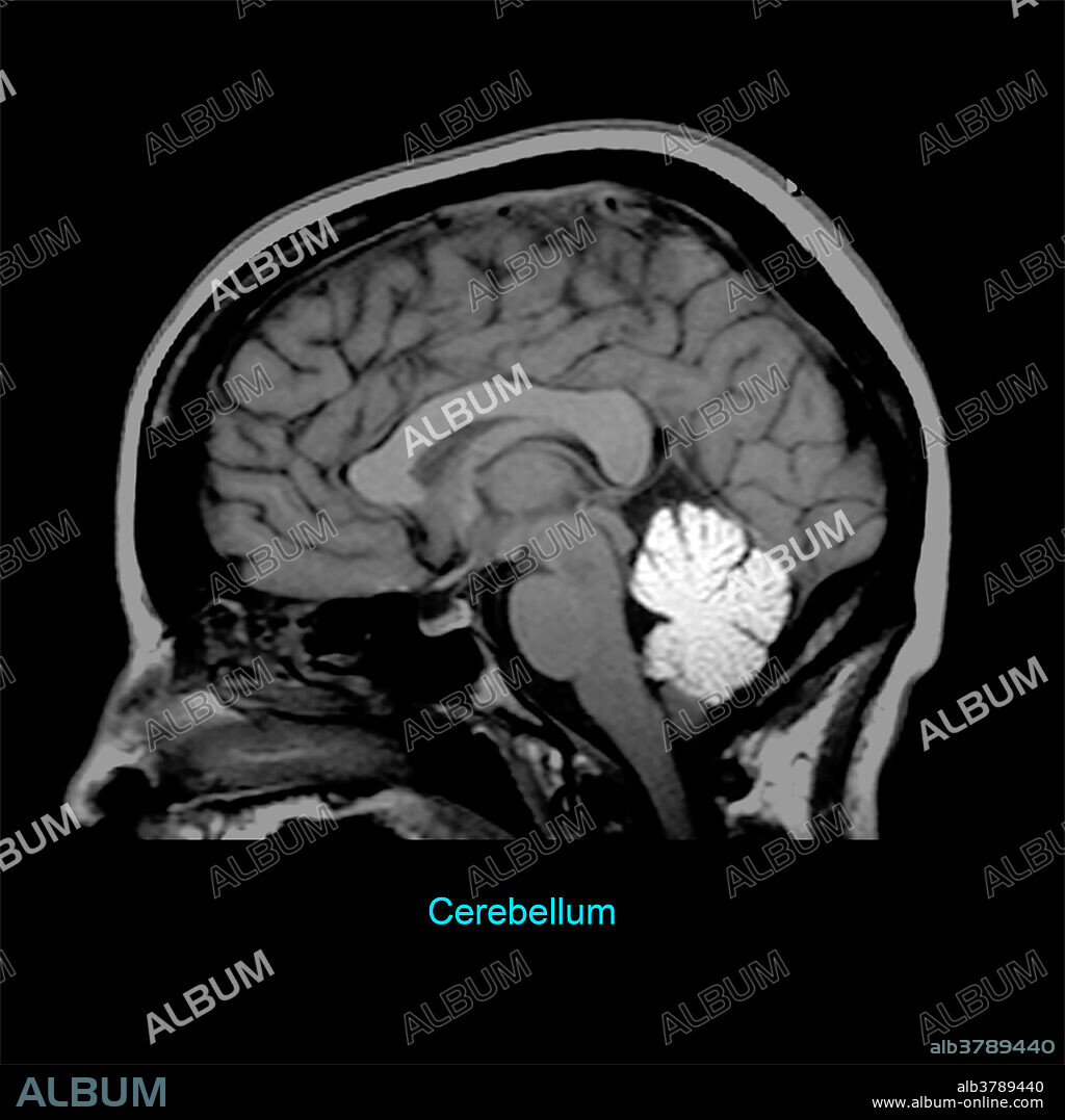 This T1 weighted sagittal (from the side) image of the brain highlights the vermis of the cerebellum.