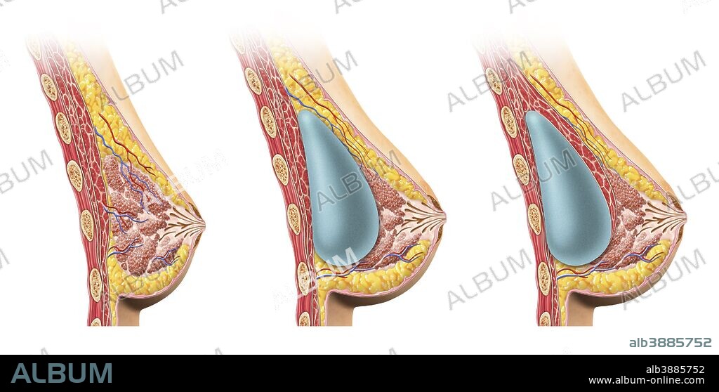 Woman breast implant cross section. Comparison diagram, under and over pectoral muscle.