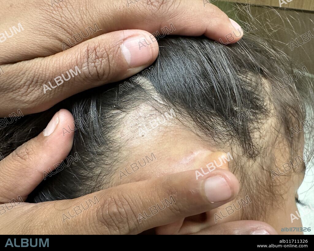Editorial use only. Ringworm infection a patient's scalp. Ringworm is a disease caused by a fungal infection of the skin. This cause was caused by Microsporum fungus. It causes severe itching. The disease is highly contagious, and can be spread by direct contact or by contact with contaminated material. Treatment is with antifungal drugs.